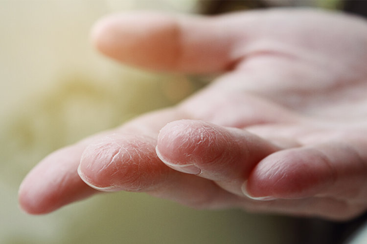 What is dry skin?